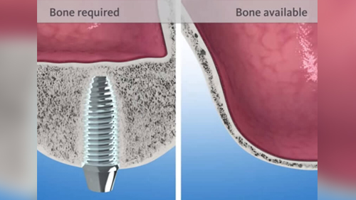 Sinus Lift